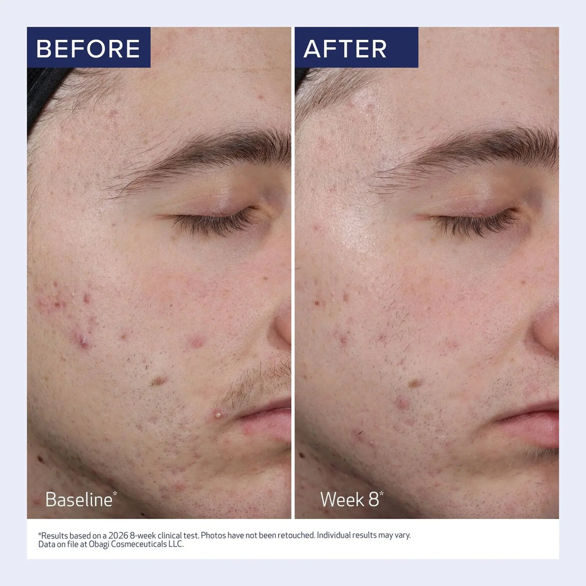 Obagi | CLENZIDERM M.D. Resurfacing Multi-Acid Peel Pads (30 Pads)