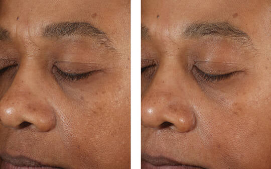 Skinbetter Science A-Team Duo Advanced Kit