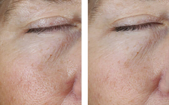 Skinbetter Science Instant Effect Gel EYE