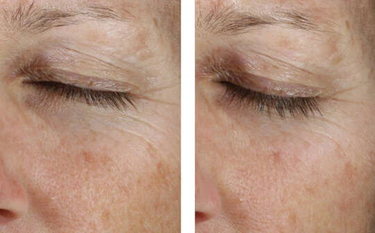 Skinbetter Science Instant Effect Gel EYE