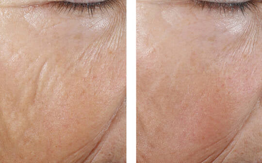 Skinbetter InterFuse Intensive Treatment LINES